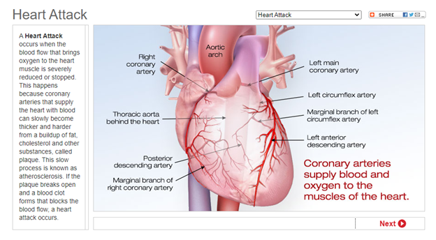 Heart Attack from the American Heart Association